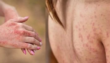 Kelebek hastalığında hayati tehlike: Uzmanlardan Lupus uyarısı