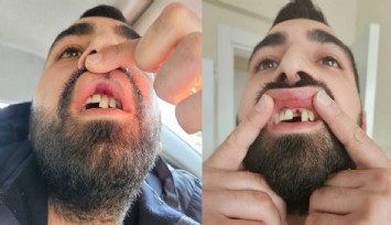 Akaryakıt İstasyonu'nun kapısını açık unuttu: Dileri kırıldı