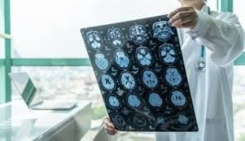 Beyin 30’lu yaşlarda küçülmeye başlıyor: Alzheimer’a karşı kritik uyarı