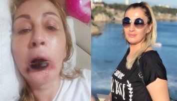 Estetik işlem sonrası dudağı çürüdü, 7 yıldır hukuk mücadelesi veriyor